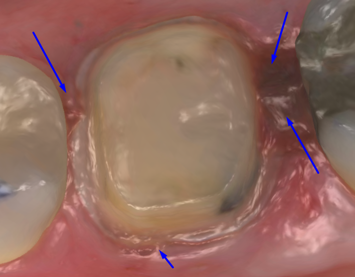 Margin partially obscured by tissue and crevicular fluid