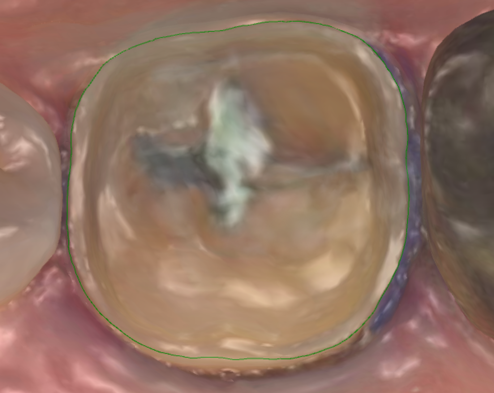 Clear supragingival margin with dry field and continuous finish line