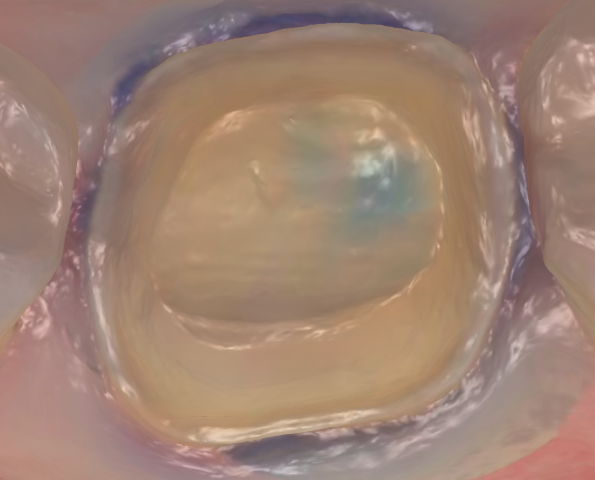 Retracted tissue with visible margin and minor fluid at one area