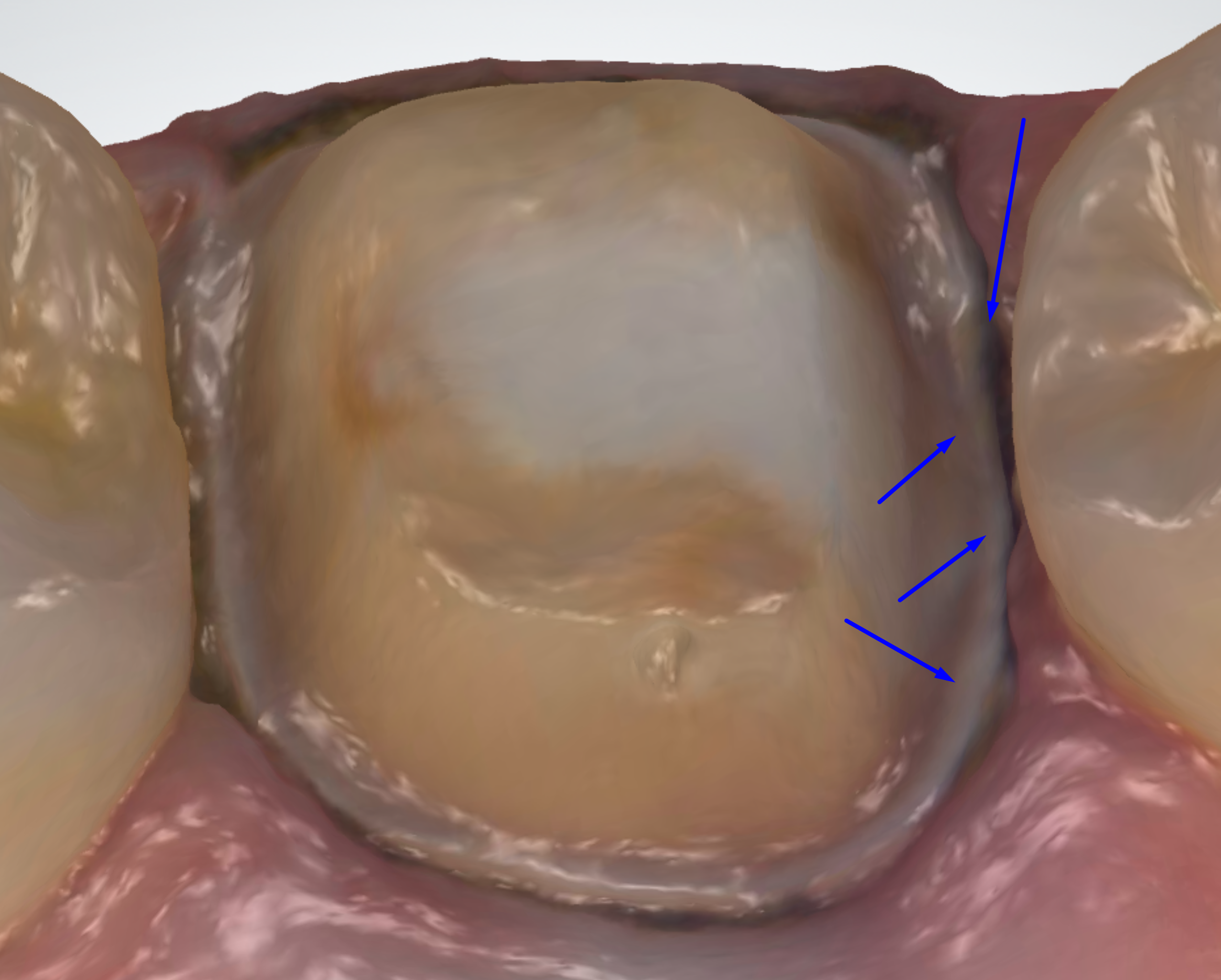 Pooling saliva causing glare and loss of detail at the finish line